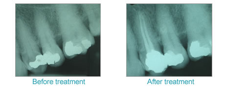 Root canal treatment
